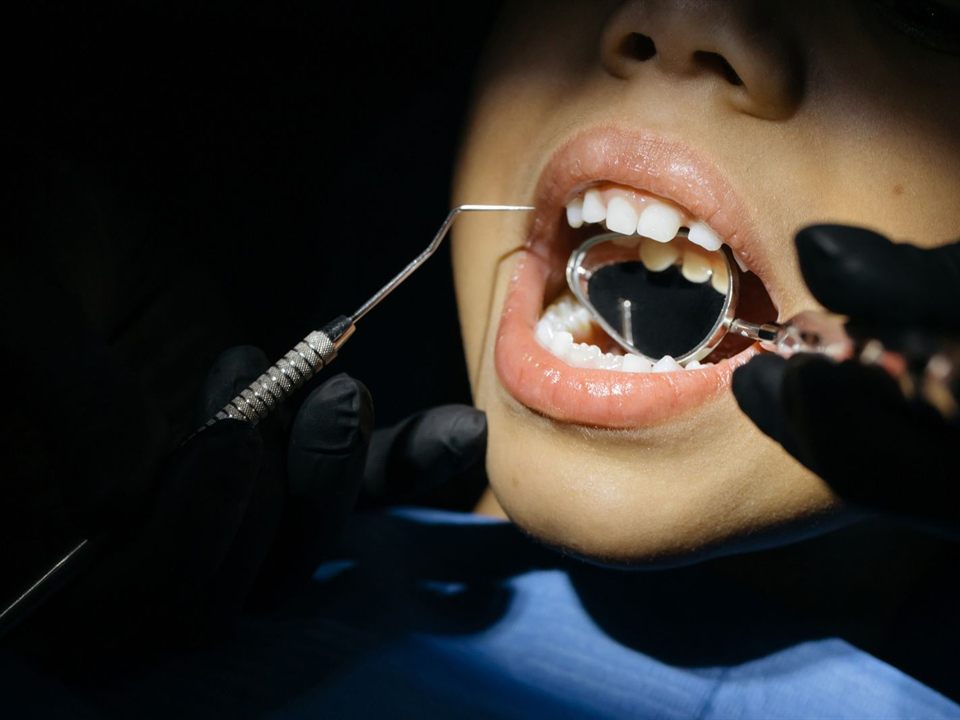 Close-up of a dentist examining a child's teeth before silver diamine fluoride treatment in Christiansburg, VA