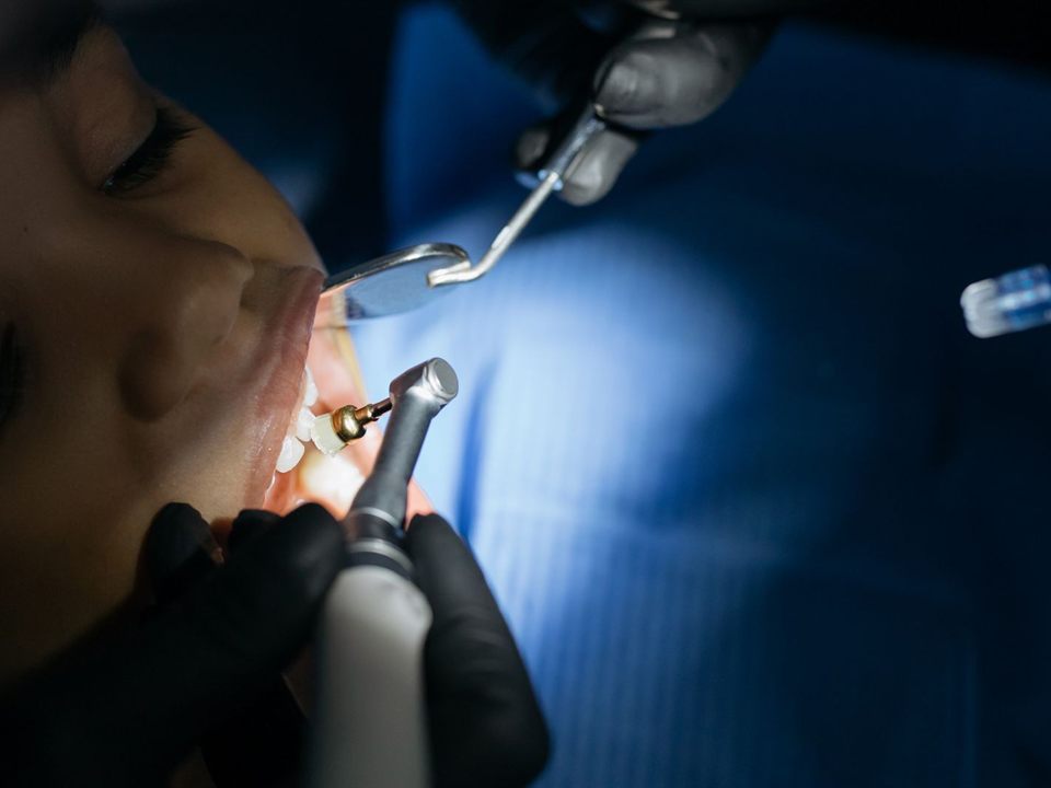 Close-up of a dentist placing a tooth-colored filling for a child at our pediatric dentist office in Christiansburg, VA